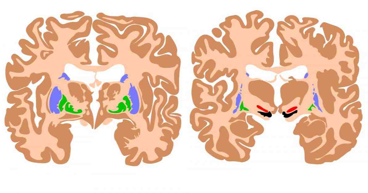 15 potravín, ktoré poškodzujú zdravie nášho mozgu / neurovedy