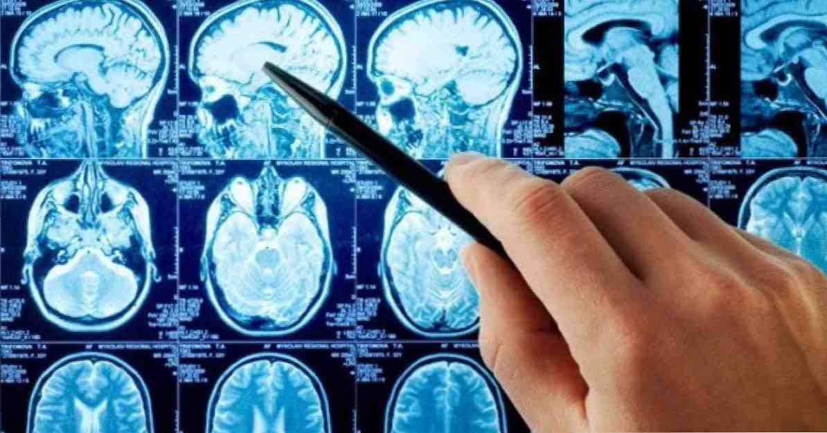Príčiny, symptómy a prognóza mozgovej aneuryzmy / Lekárstvo a zdravie