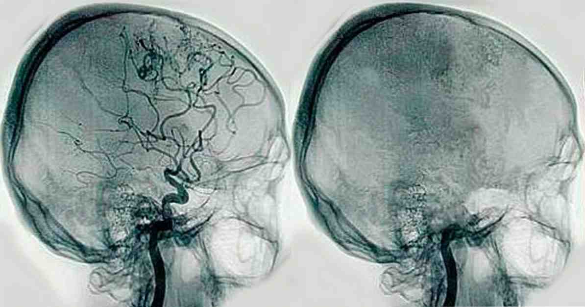 Mi az agyi angiográfia és milyen rendellenességek észlelhetők? / Klinikai pszichológia