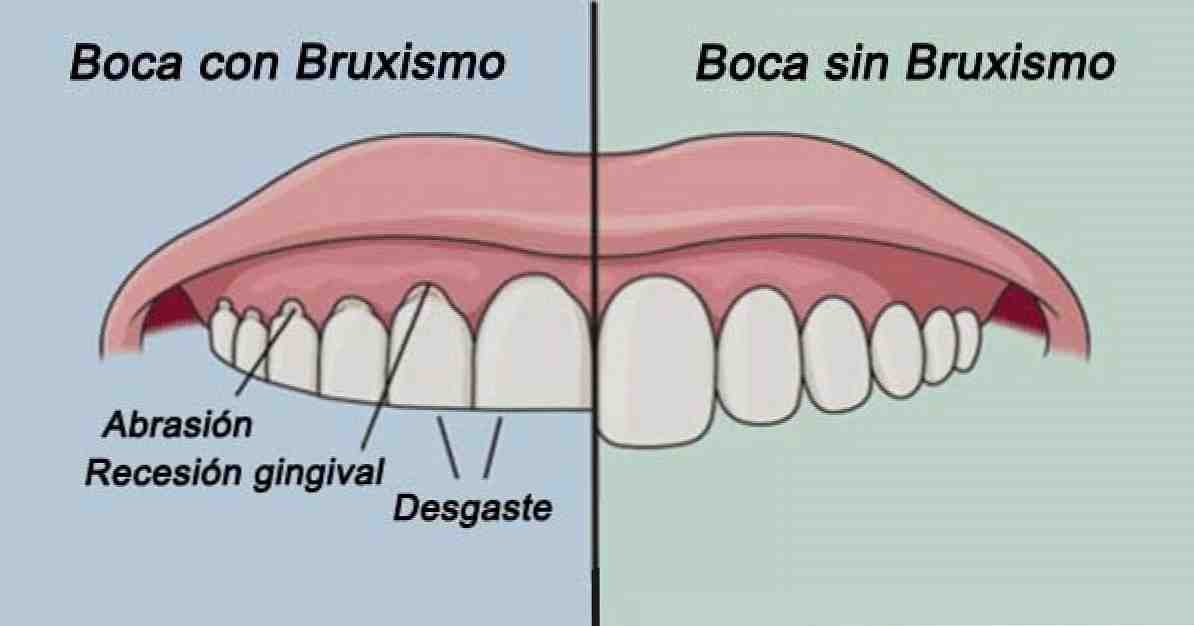Bruxismus (broušení zubů) příčiny, příznaky a léčba / Klinická psychologie