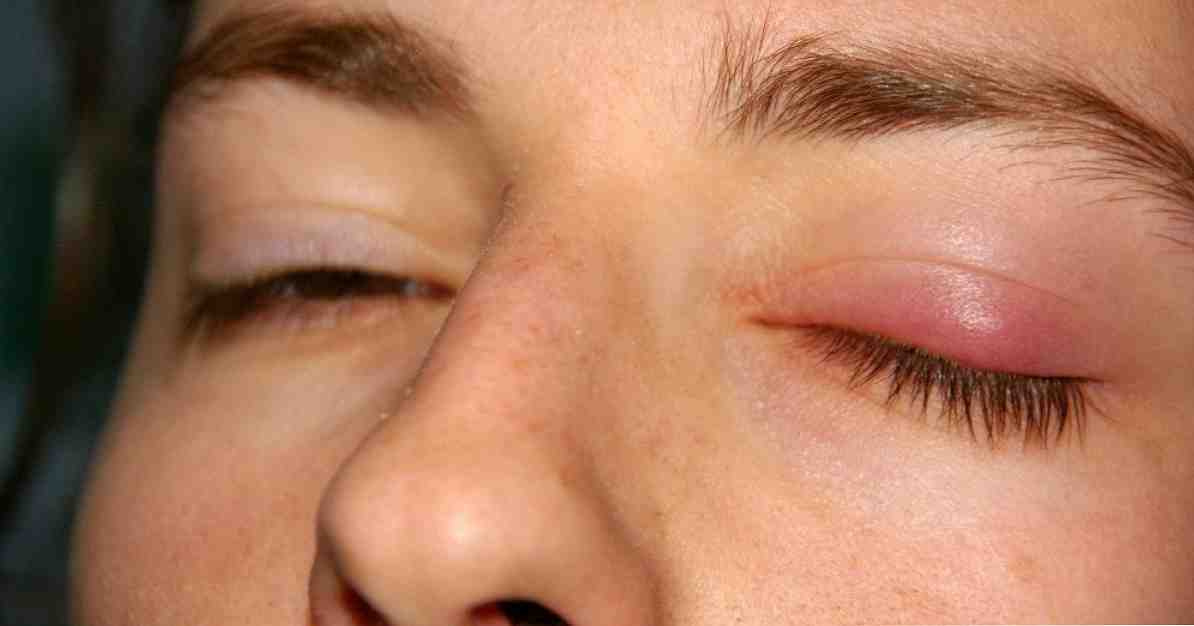 Wie man einen Stye in 7 einfachen Schritten heilt / Medizin und Gesundheit