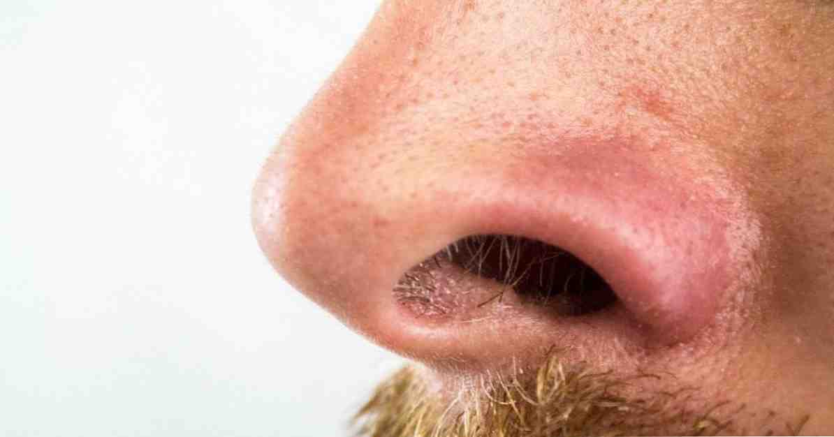 כיצד להסיר blackheads מן האף 7 טריקים ותרופות