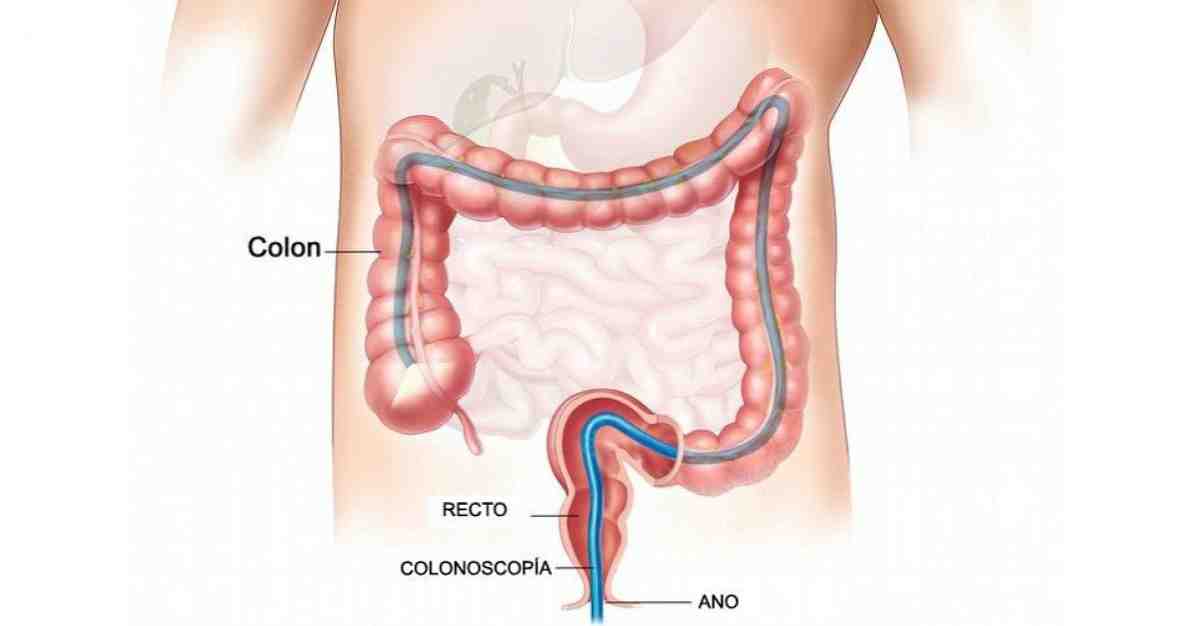 大腸内視鏡検査この医療検査は何に使用されますか？ / 医学と健康