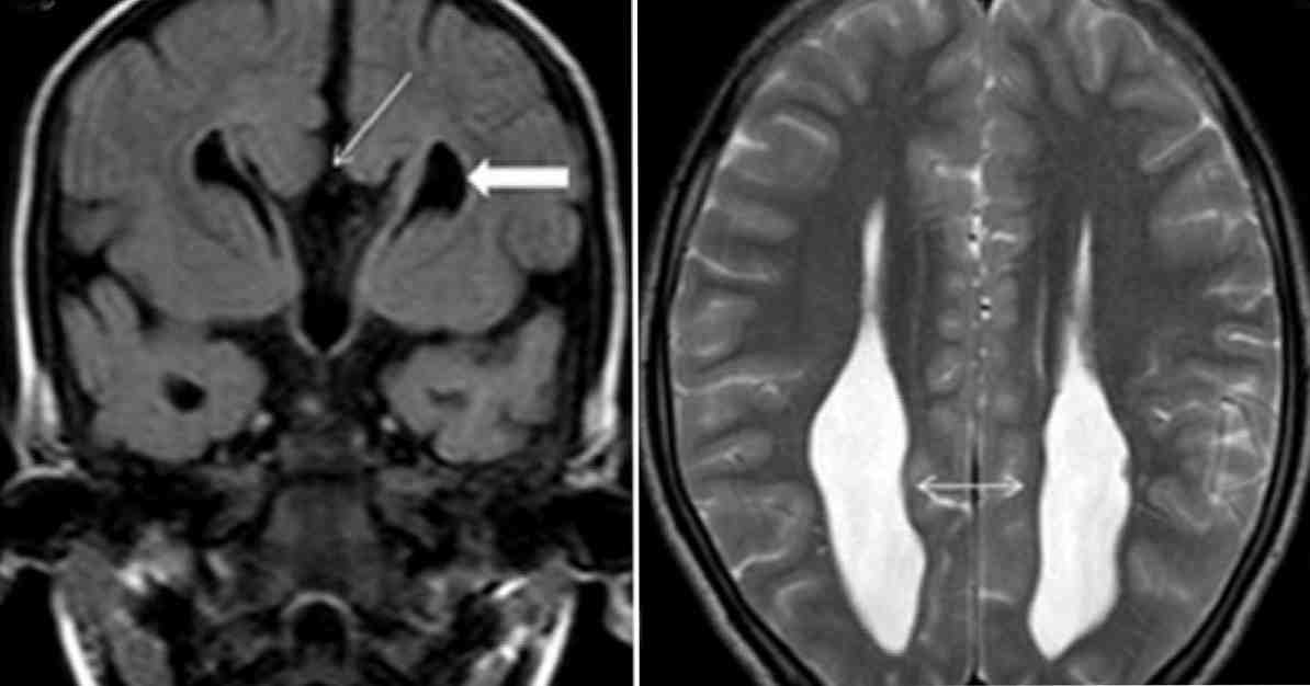 Colpocephaly, mis see on, põhjused, sümptomid ja ravi