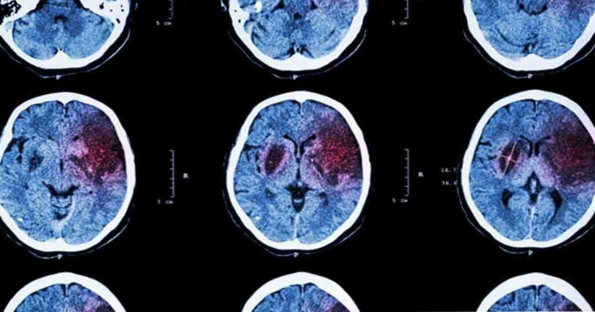 Stroke definition, årsager, symptomer og behandling