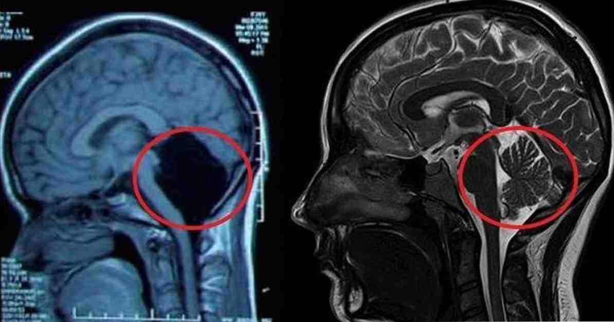 Neobičan slučaj žene bez cerebeluma koja je iznenadila znanstvenu zajednicu / neuroznanosti