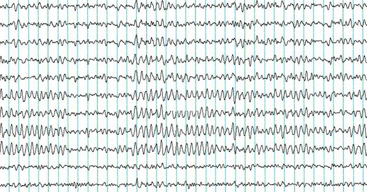 Elektroentsefalogramm (EEG) Mis see on ja kuidas seda kasutatakse? / Neuroteadused
