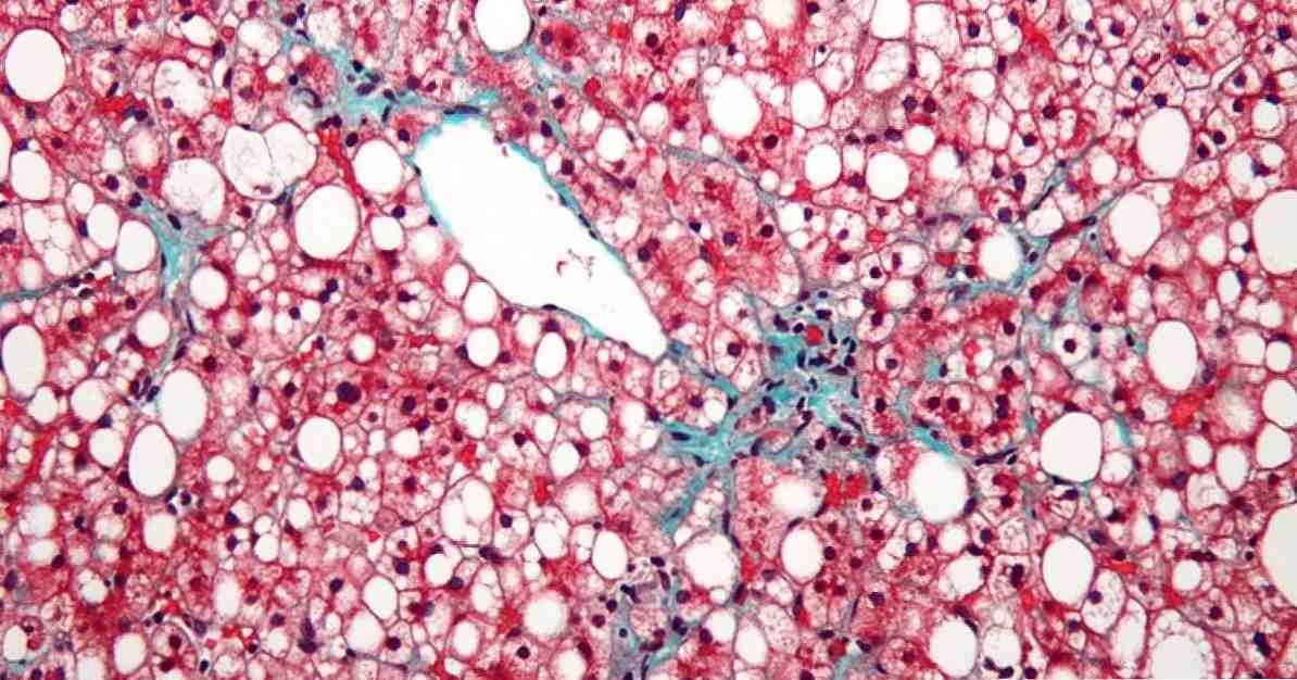 ตับ steatosis (ตับไขมัน) ทำให้เกิดอาการและประเภท / ยาและสุขภาพ