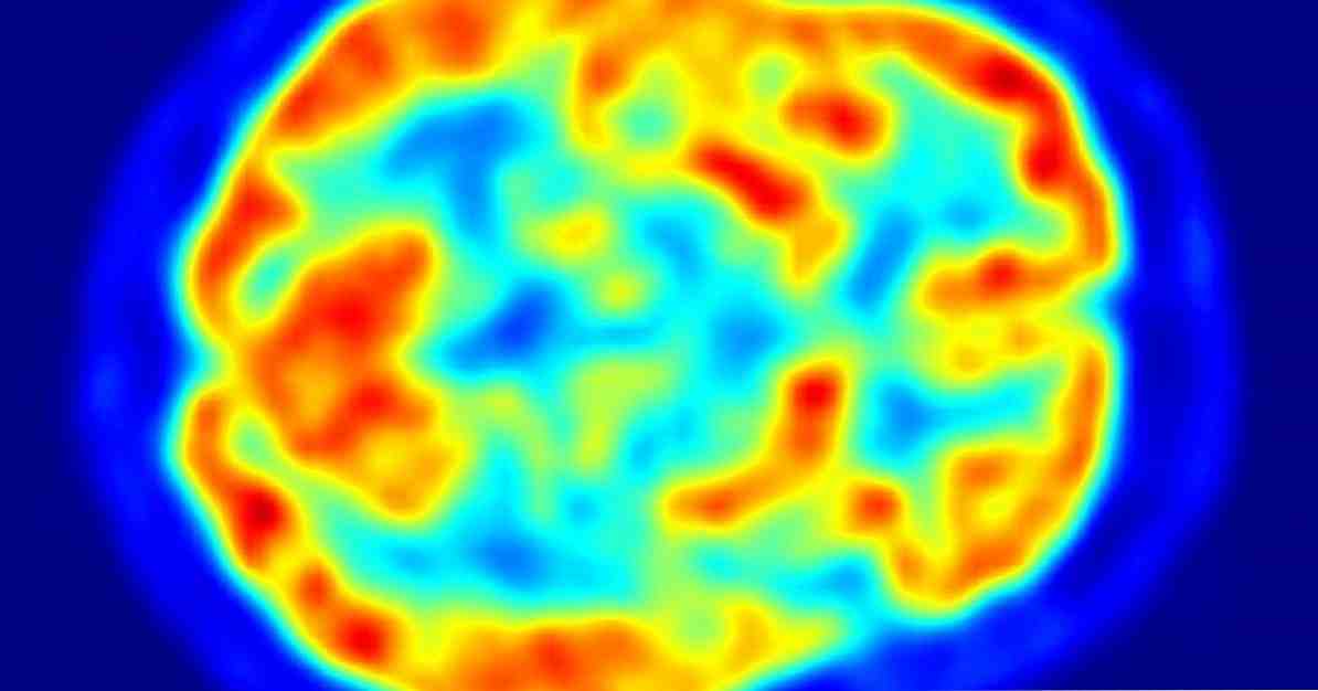 Hypersexuality Apa yang berlaku di otak penagih seks? / Neurosains