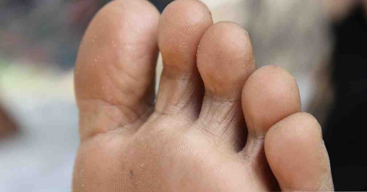 Fungo nos pés causa sintomas e tratamento / Medicina e saúde
