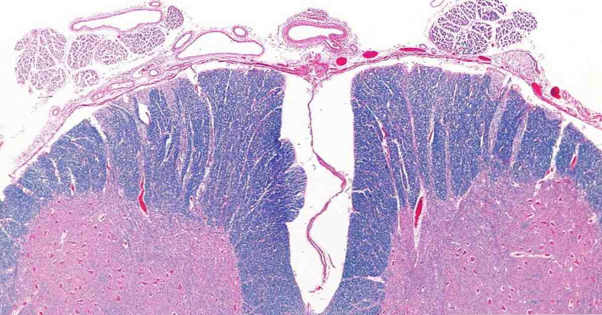 I 2 tipi di sintomi di mielite, cause e trattamento