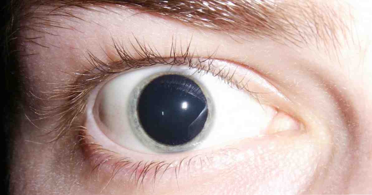 Mydriase (dilatation extrême de la pupille) symptômes, causes et traitement