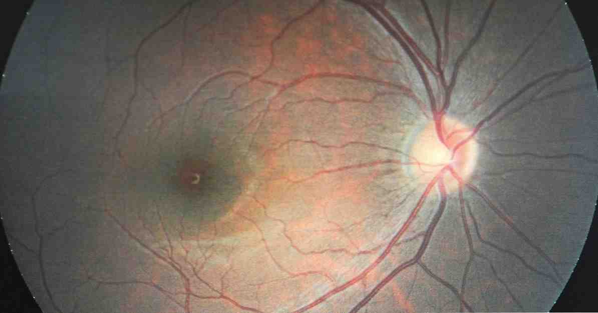 Optinės nervų dalys, kelionės ir susijusios ligos / Neurologijos