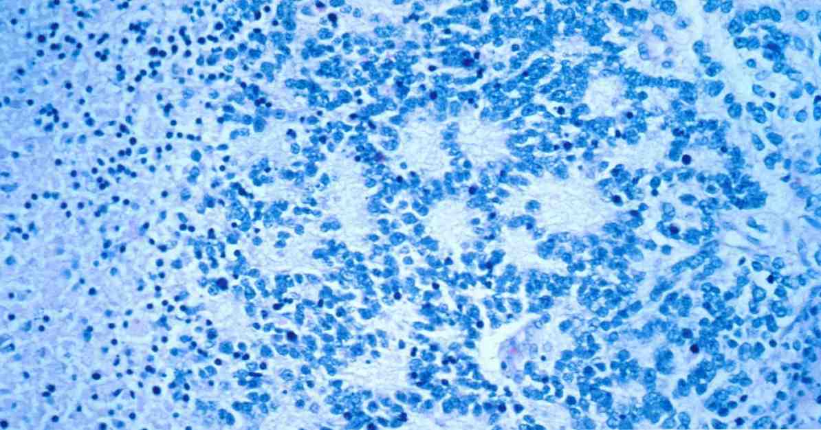 อาการ Neuroblastoma ขั้นตอนและการรักษา