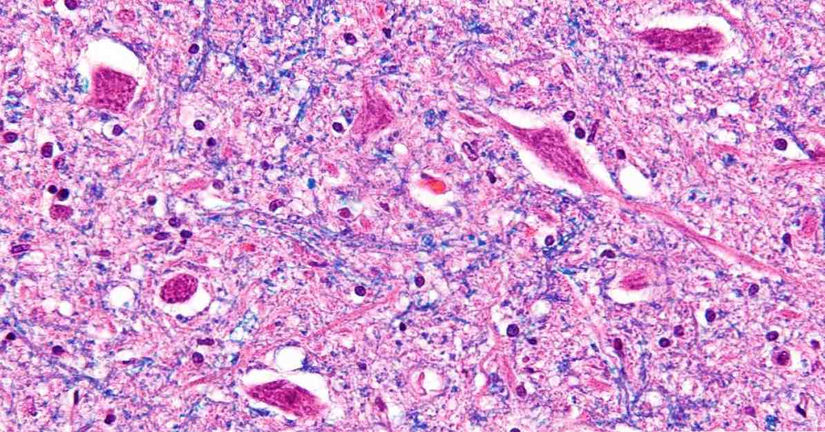 Definitie, types en pathologieën van motorneuronen / neurowetenschappen