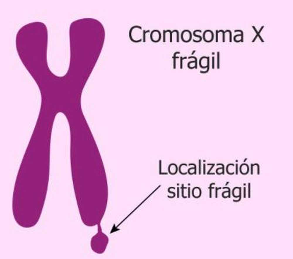 Психічна затримка, пов'язана з Х-хромосомою Х-крихкого синдрому