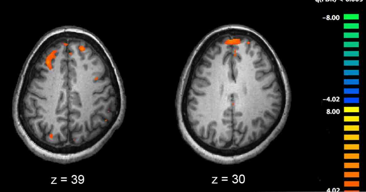 Die Forschung hat gezeigt, dass Schizophrenie die Manifestation von acht genetischen Mutationen ist