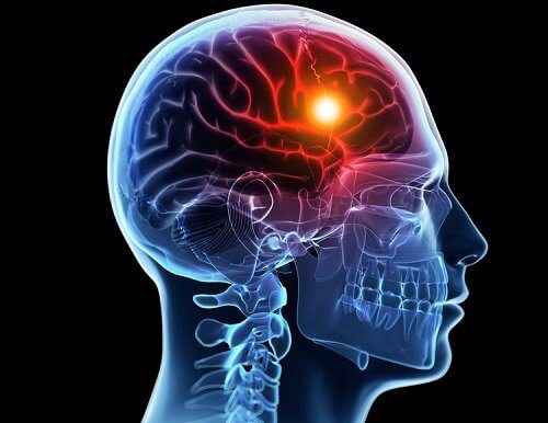 Causas e tipos de acidentes vasculares cerebrais / Neurociências